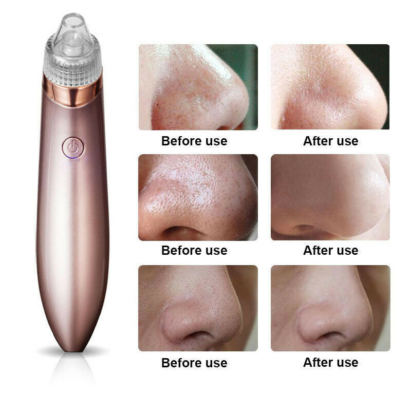 Electric Blackhead Vacuum Pore Cleaner Acne Pimple Remover Strong